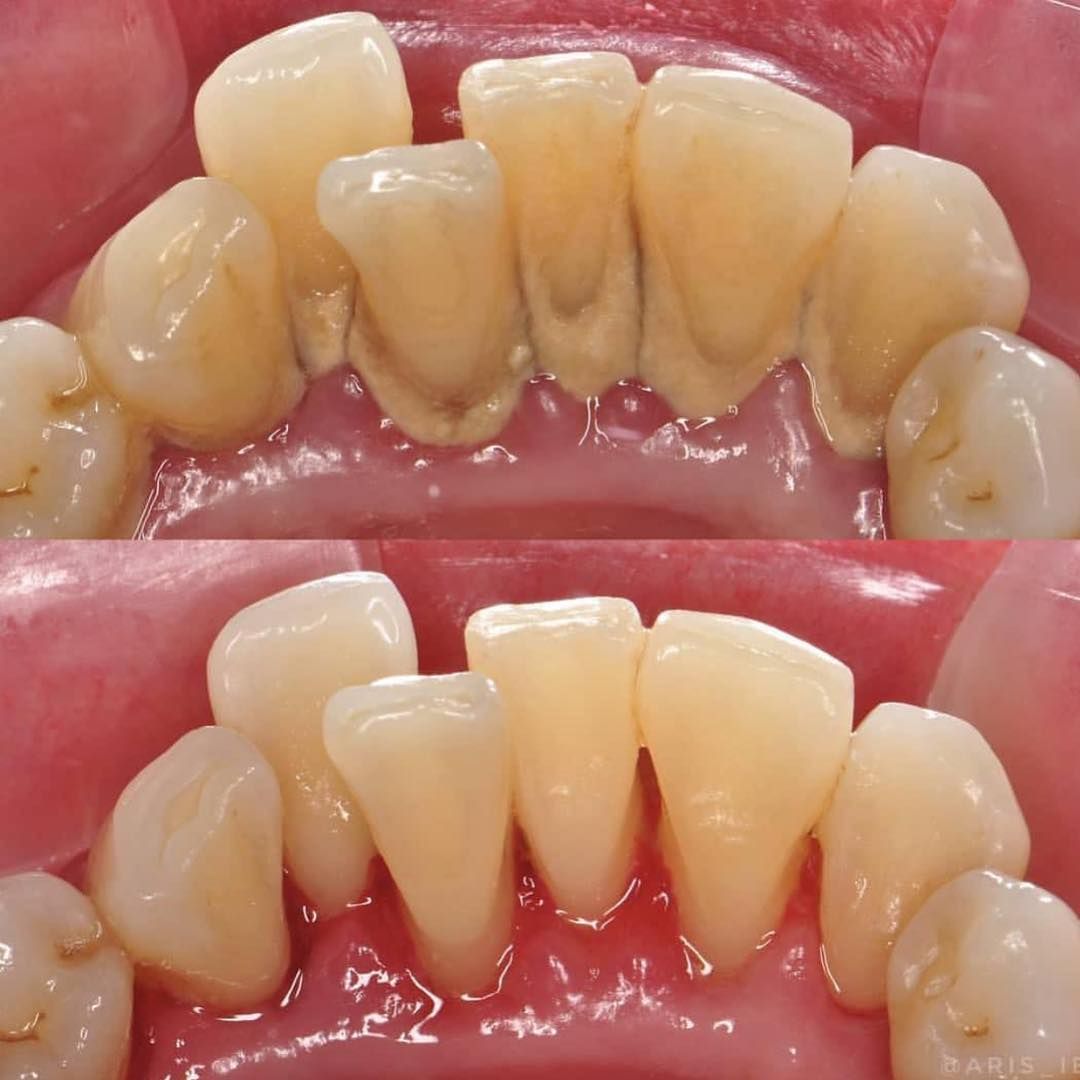 Teeth Scaling Procedure | News | Dentagama