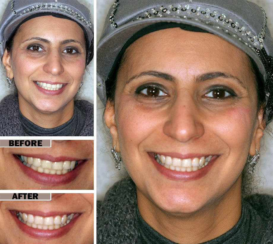 Teeth Cleaning in Brooklyn, NY | Affordable Same Day Teeth CleaningEnvy Smile Dental Spa