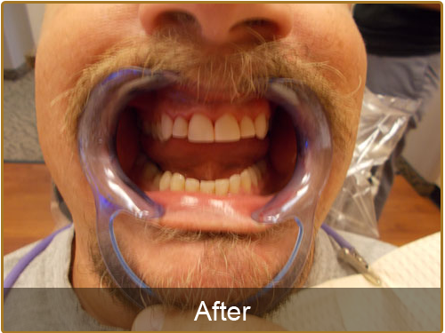 Teeth Cleaning Dentistry | Teeth Deep Cleaning Before and After | Dentures