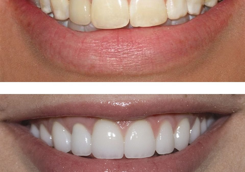 Teeth Cleaning Process | Encino