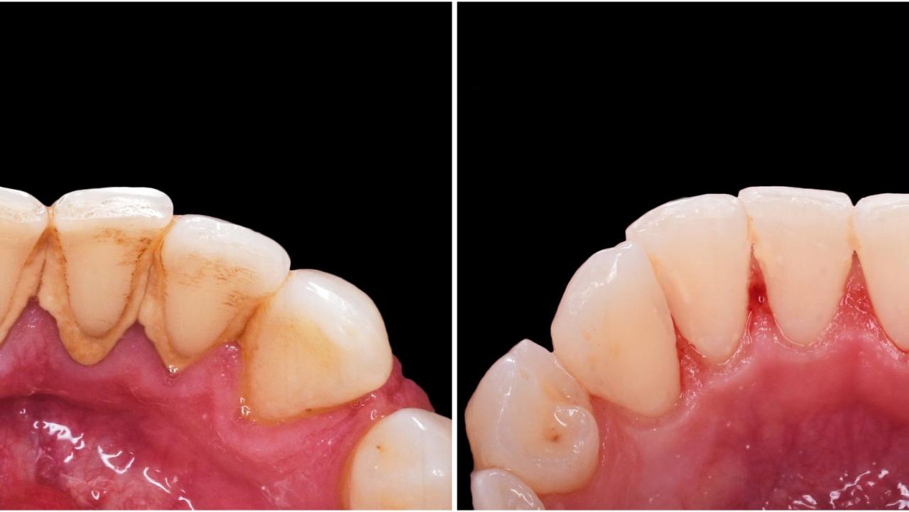 Deep Teeth Cleaning: Before and After - Dental Health Society
