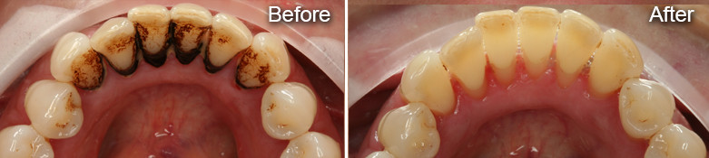 Teeth Cleaning Glenview, Highland Park, Northbrook, Deerfield, Winnetka | Preventive Dentistry IL