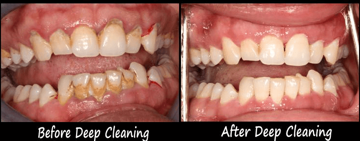 Deep Cleaning of Teeth Side Effects - How to Overcome it?